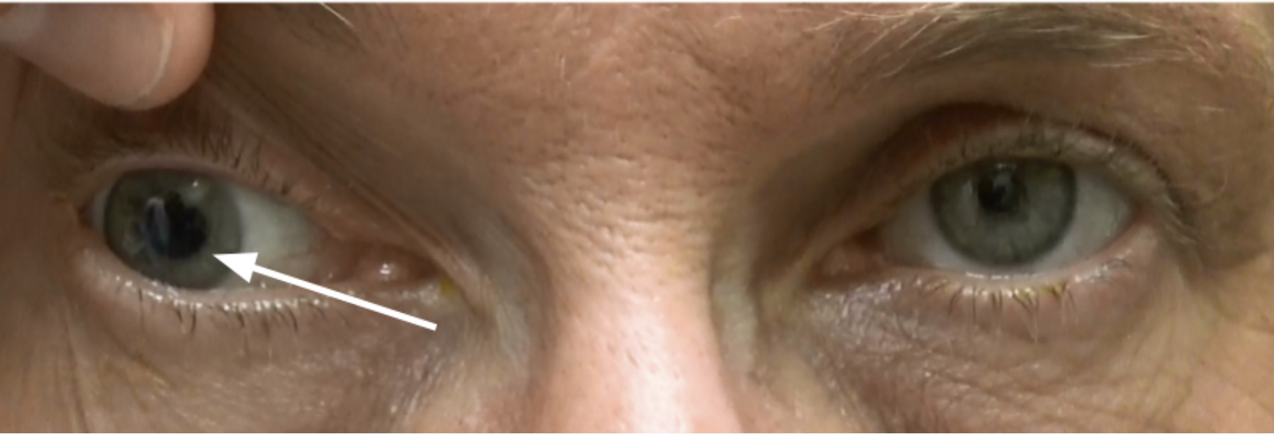 Anisocoria North American NeuroOphthalmology Society