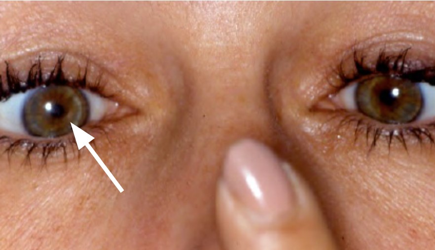 Anisocoria North American NeuroOphthalmology Society