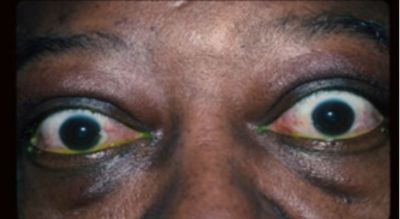 El cigarrillo y las enfermedades oculares - American Academy of  Ophthalmology