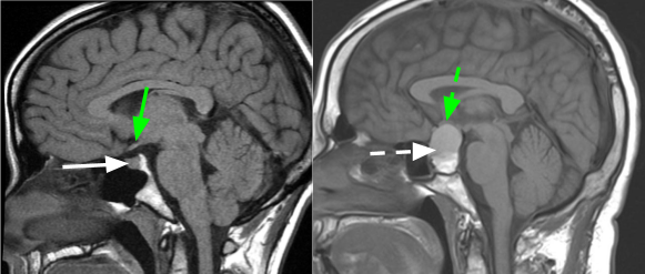 adenoma hypophysis mri